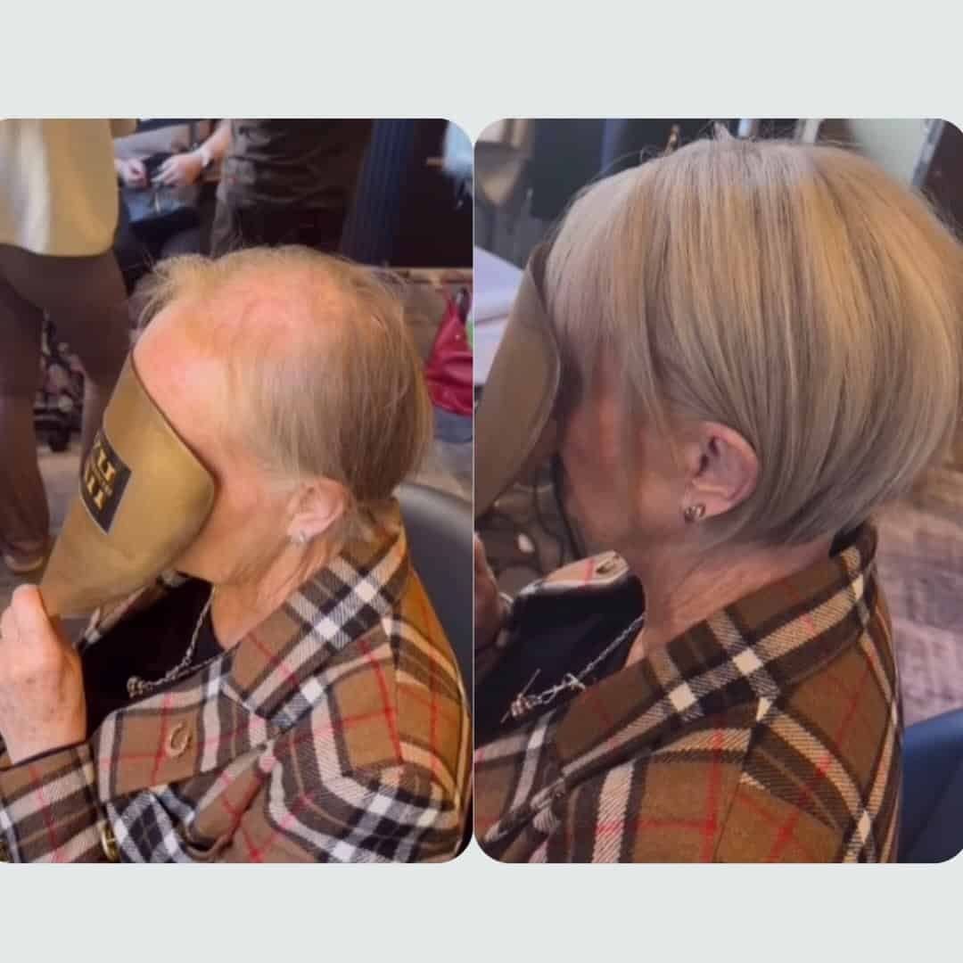 Before and after: KHG Hair Enhancers hair enhancer result for a client with hair loss